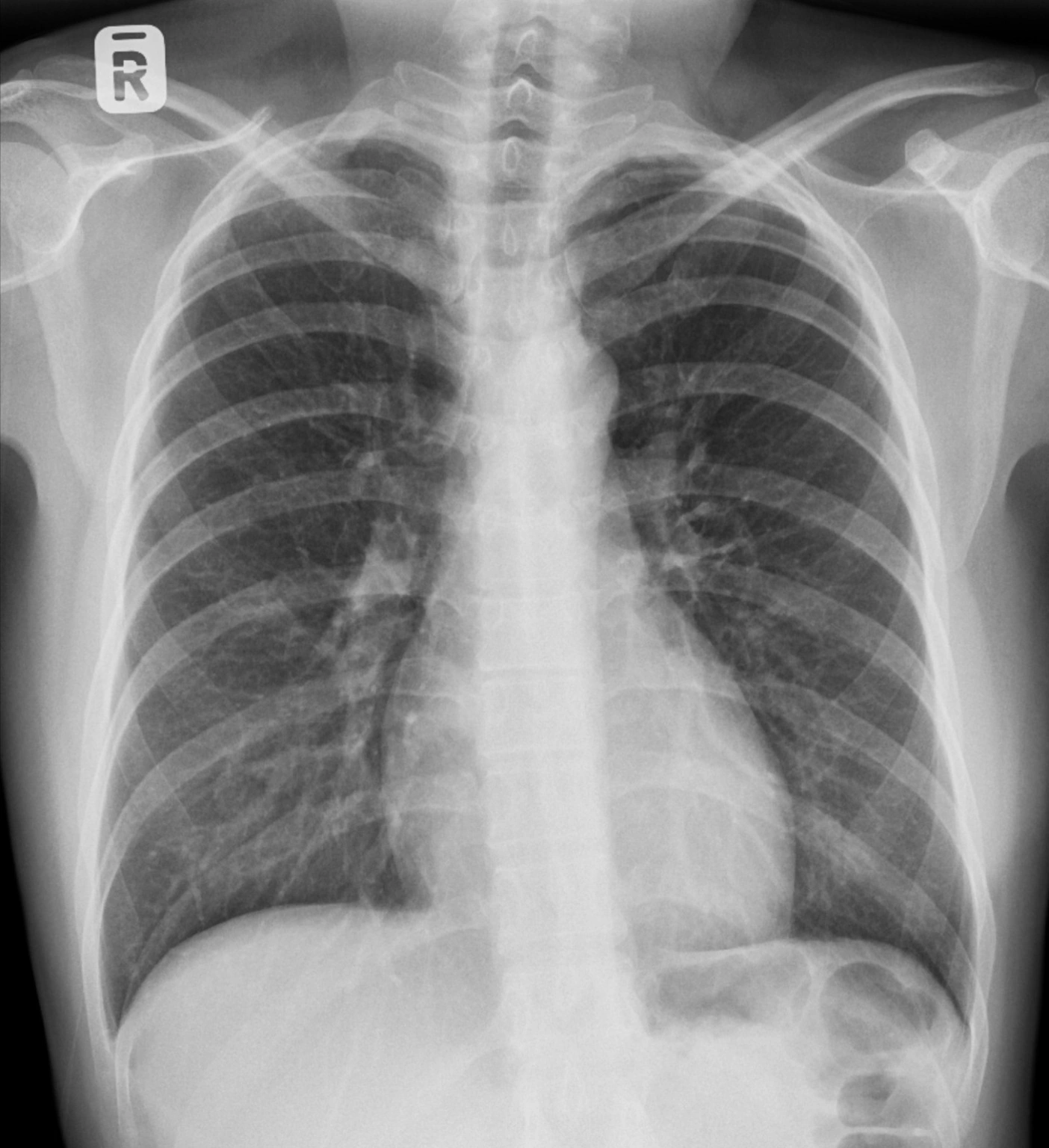 Anonymised chest X-ray image