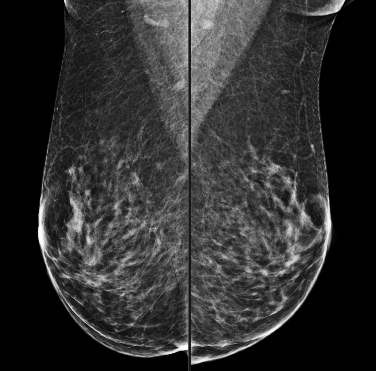Anonymised mammogram image