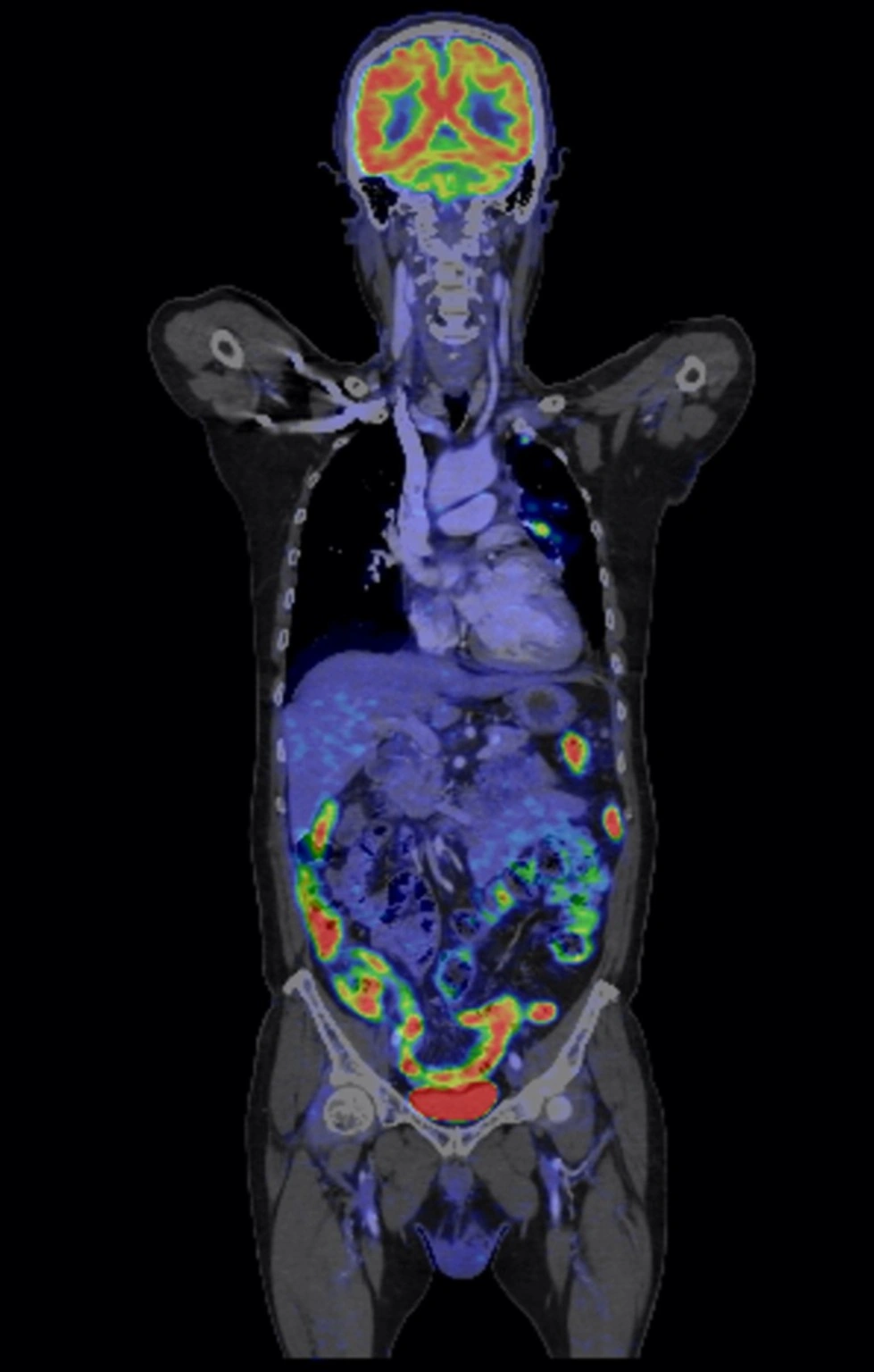 Anonymised PET-CT scan image